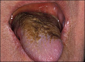 Hairy Tongue Disorder 97